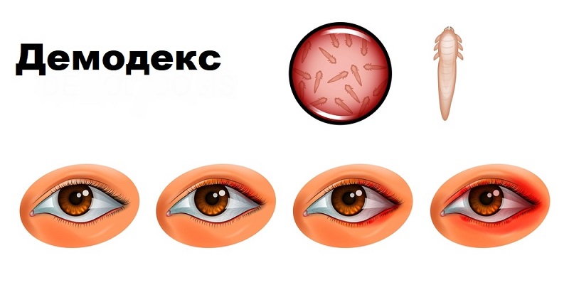 Как да излекуваме ечемика на окото си - За Жената